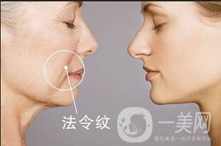 自體脂肪填充法令紋多少錢 