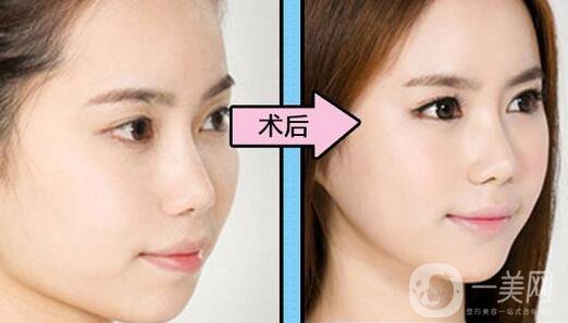 做墊下巴有什么方法