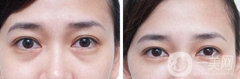 自體脂肪填充淚溝修復(fù)價(jià)格