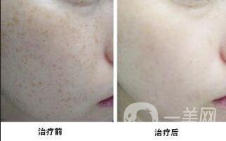 c6激光祛斑貴嗎 術(shù)后如何護(hù)理