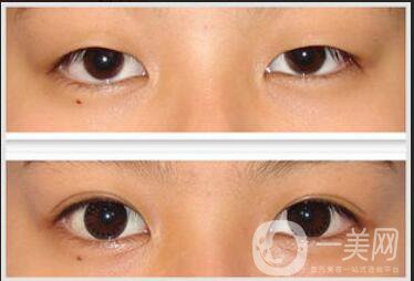 杭州割雙眼皮多少錢,雙眼皮加開眼角費(fèi)用