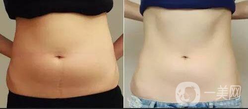 腹部溶脂恢復(fù)過(guò)程