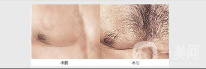 種植胸毛價格