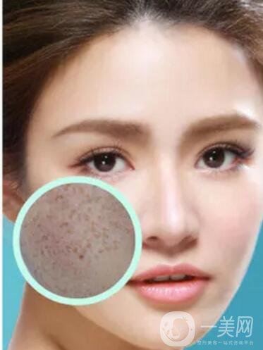 長了黃褐斑怎么辦 光子嫩膚調(diào)節(jié)黃褐斑價格