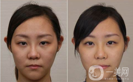 拉皮是不是可以除皺,拉皮除皺*果怎么樣