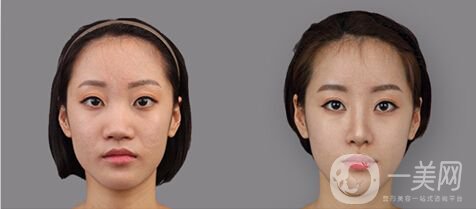 鼻頭縮小術注意事項,手術縮鼻頭有用嗎