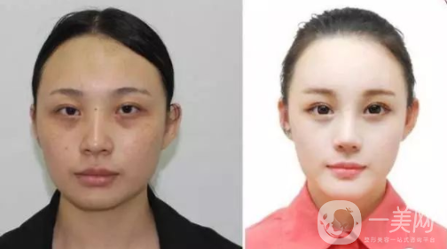 光子嫩膚價(jià)格多少錢,什么是光子嫩膚