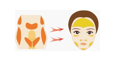 自體脂肪填充恢復期要多久時間