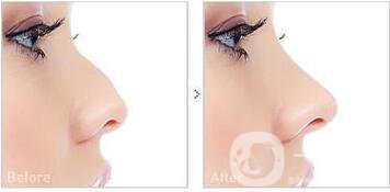 耳軟骨隆鼻整形價(jià)格