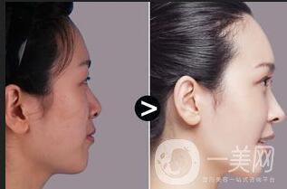 硅膠隆鼻*果,硅膠隆鼻多久消腫