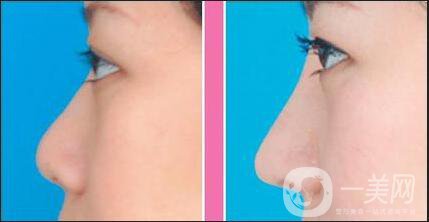 耳軟骨隆鼻手術(shù)多少錢(qián)