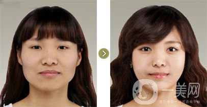 下頜角手術(shù)后遺癥都有哪些呢？