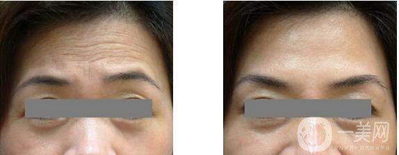 抬頭紋如何形成的 抬頭紋很深怎么辦？