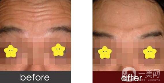 抬頭紋如何形成的 抬頭紋很深怎么辦？