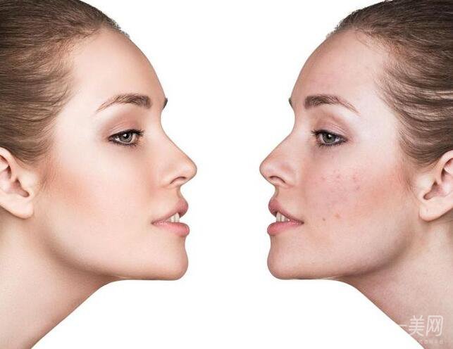 光子嫩膚是什么 價(jià)格多少？