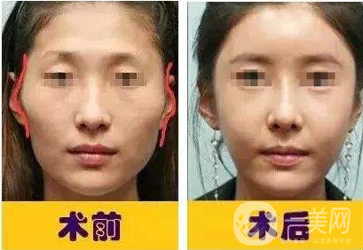 臉上顴骨突出怎么辦 磨顴骨方法有哪些