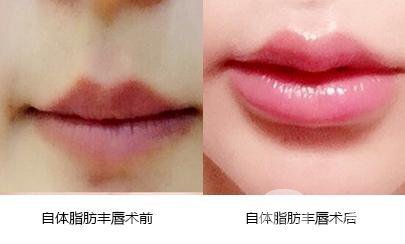 什么樣的人適合豐唇 豐唇方法有哪些