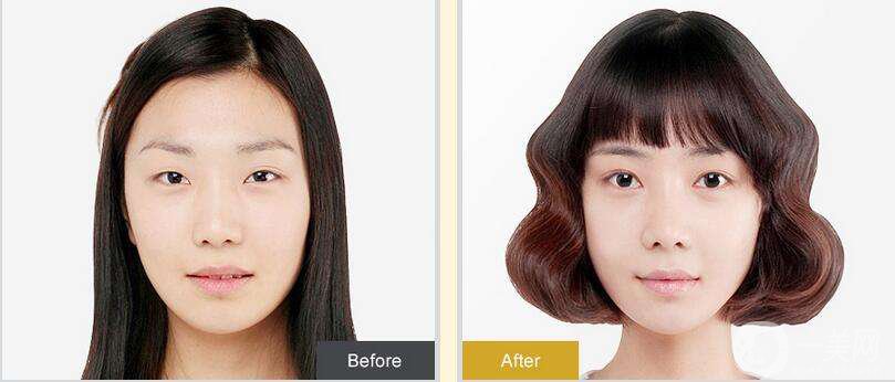 割雙眼皮三天能不腫嗎 多長(zhǎng)時(shí)間能消腫