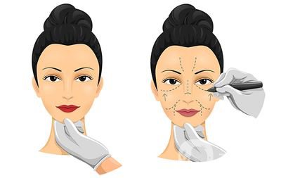 福州面部拉皮除皺價格是多少