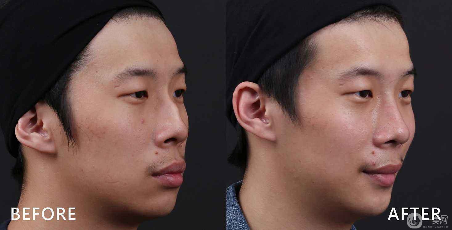 駝峰鼻矯正價(jià)格貴嗎 駝峰鼻如何矯正