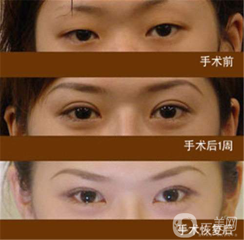 生物焊接雙眼皮多少錢？*果怎么樣？