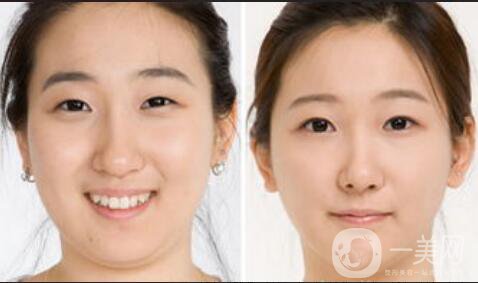 吸脂瘦臉*果,吸脂瘦臉后遺癥