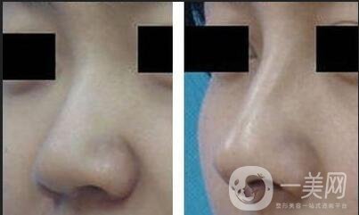 耳軟骨隆鼻*嗎,耳軟骨隆鼻多少錢(qián)