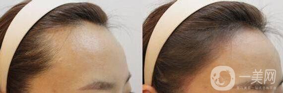 植發(fā)價(jià)格,植發(fā)多少錢