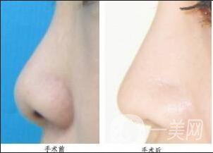 鼻翼縮小多少錢,注意事項(xiàng)