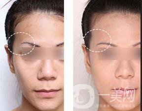 膨體豐太陽(yáng)穴報(bào)價(jià),膨體豐太陽(yáng)穴注意事項(xiàng)