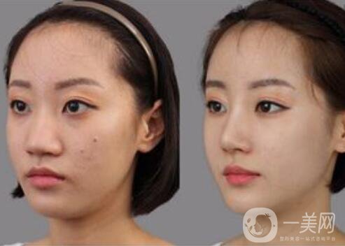 鼻頭縮小手術(shù)費(fèi)用,鼻頭縮小術(shù)后注意事項(xiàng)