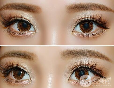 玻尿酸填充臥蠶價格,玻尿酸填充臥蠶風險