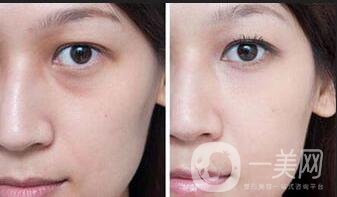 自體脂肪填充醫(yī)院