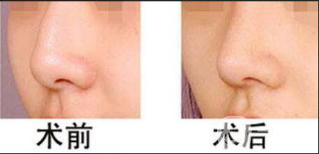 駝峰鼻矯正價(jià)錢(qián)一般是多少錢(qián)