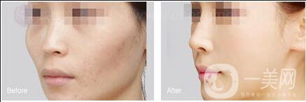 自體脂肪填充危害,自體脂肪填充注意事項