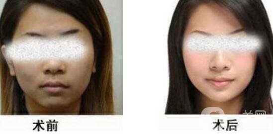 黑臉娃娃縮小毛孔多少錢？