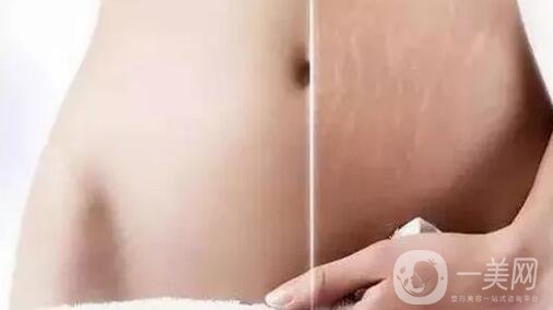 去妊娠紋價(jià)格是多少？