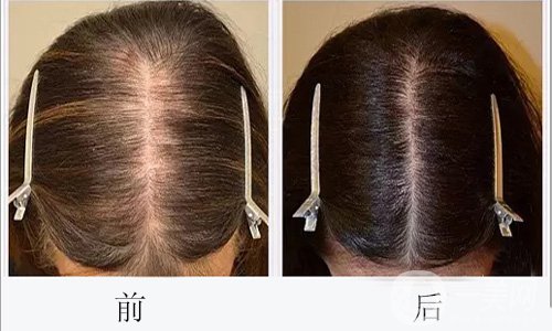 植發(fā)做完會(huì)出現(xiàn)后遺癥嗎 植發(fā)護(hù)理方法