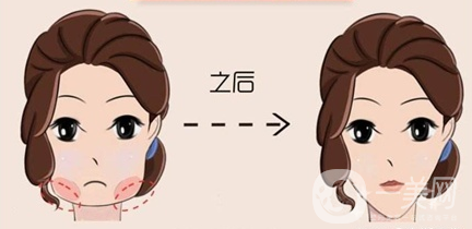 下頜角手術(shù)恢復(fù)多久 多久消腫呢