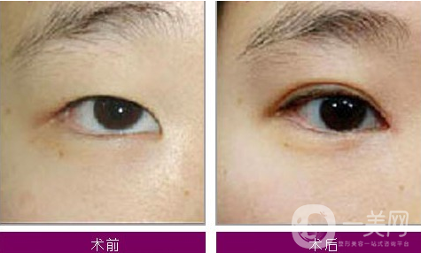 雙眼皮做失敗了還能做第二次嗎