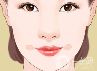 酒窩成形術(shù)的價格 酒窩做什么手術(shù)