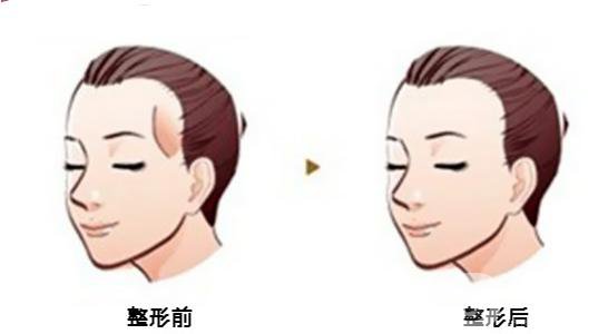 硅膠豐太陽穴貴嗎 硅膠豐太陽穴價(jià)格