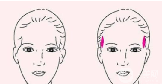 膨體豐太陽(yáng)穴報(bào)價(jià) 膨體豐太陽(yáng)穴的*果