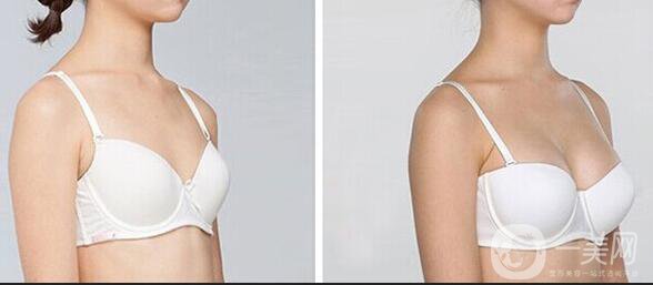 抽脂隆胸整形手術價格,自體脂肪隆胸注意事項