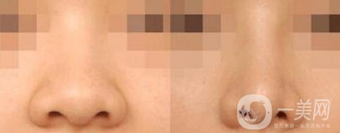 鼻翼縮小價位,鼻翼縮小術后護理