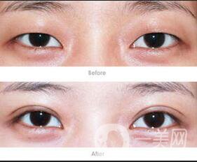 歐式雙眼皮貴嗎,歐式雙眼皮價格