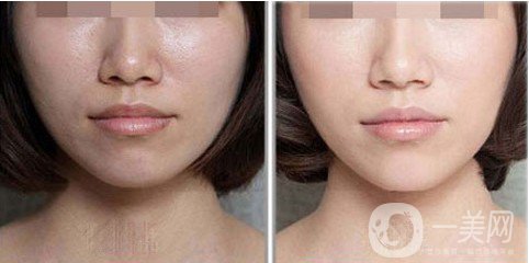 鐳射激光嫩膚是什么 主要有哪些作用？