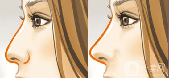 自體隆鼻手術(shù)價(jià)格 自體脂肪填充的方法