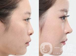 玻尿酸隆鼻費(fèi)用貴不貴 注射玻尿酸的方法