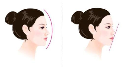 假體隆鼻手術(shù)需要多少錢 什么是妙桃假體填充